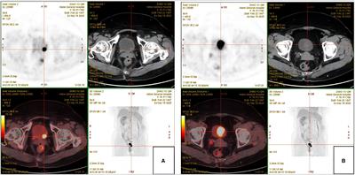 Recurrent bladder urothelial carcinoma complicated with primary bladder large cell neuroendocrine carcinoma: a case report and literature review